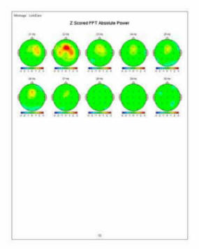 z score brain map pre treatment