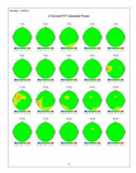 z score brain map post treatment