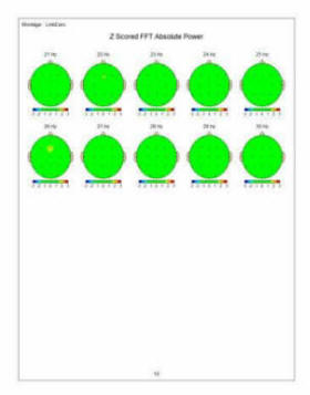 z score brain map post treatment