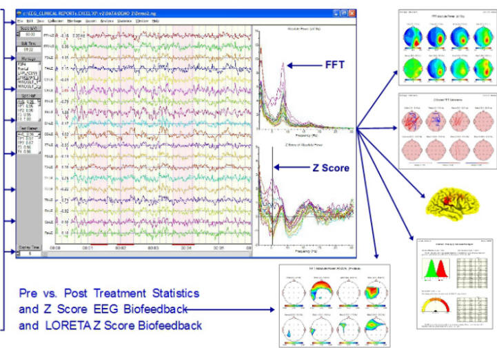 NeuroGuide qeeg software